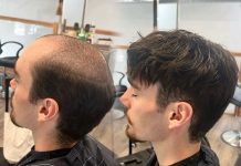 This Victoria clinic is offering free hair loss consultations for men